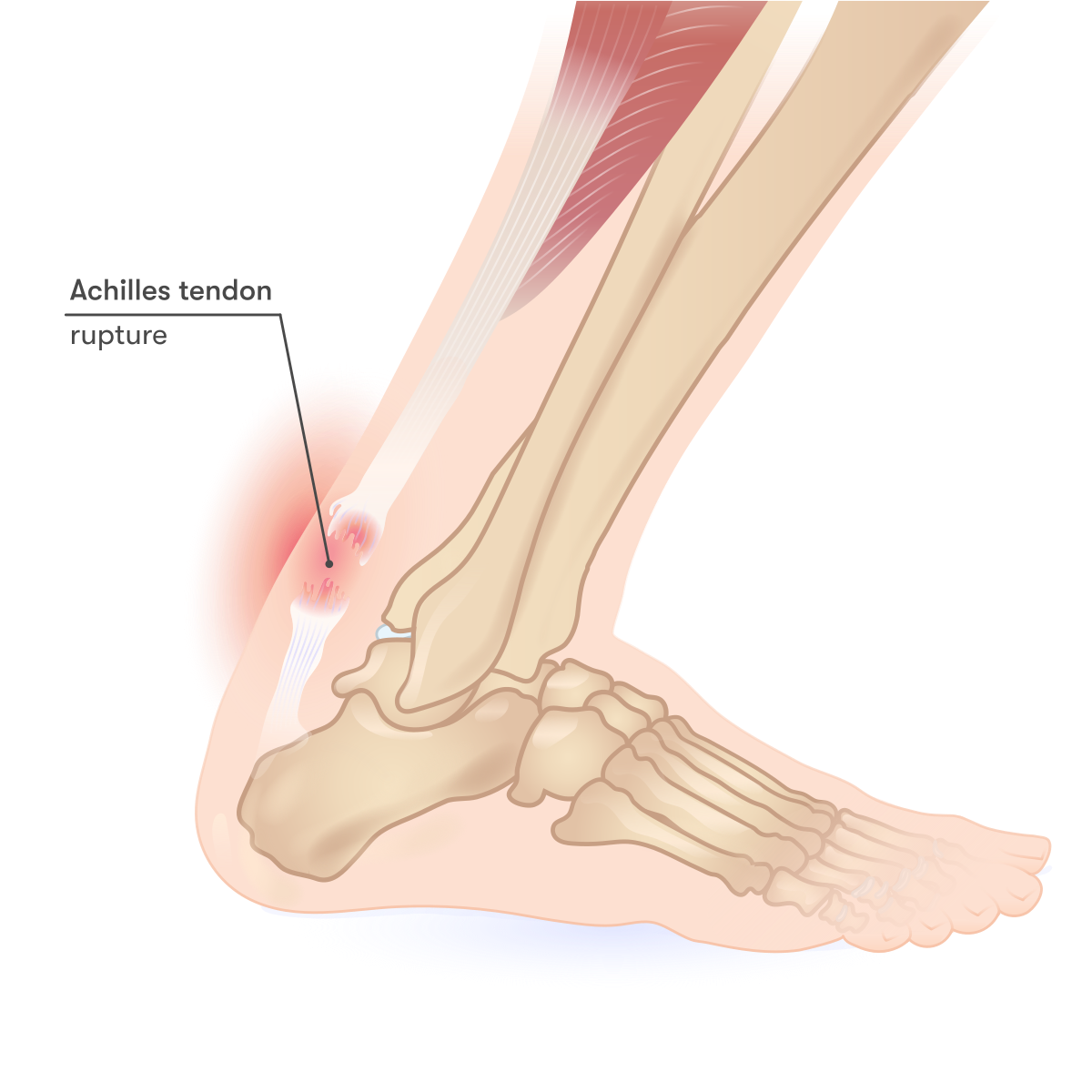 Achilles tendon - Wikipedia