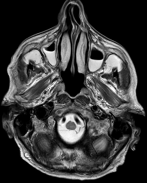 File:Akute Sinusitis maxillaris im MRT 80M - MR T2 axial - 001.jpg