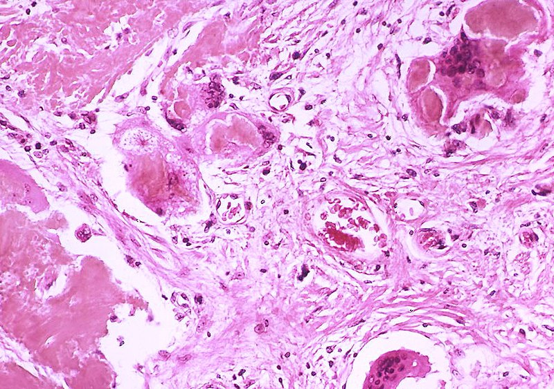 File:Amyloidosis, nodular Case 143 (5030415021).jpg