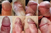 erekcióval a frenulum fáj mely péniszeket tekintik kis méretűnek