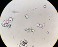 Urinary sediment showing several calcium oxalate crystals. 40X
