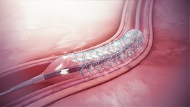 Graphic representation of a drug-eluting stent expanded into artery. The lower section is referred to as a catheter. The DES and catheter are usually one integrated medical system. The white particles represent the drug eluting into the arterial walls - inhibiting the growth of tissue into the stented area. Drug-eluting stent.jpg