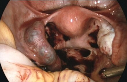 Surgical treatment: Laparoscopic view of an ectopic pregnancy