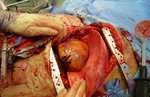 Thumbnail for Resuscitative thoracotomy