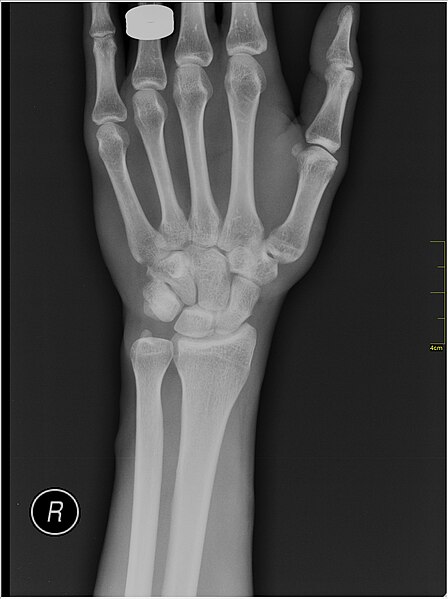 File:Medical X-Ray imaging PJL06 nevit.jpg