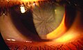 March 19: A clouded cornea in a patient with Fabry disease