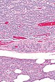 Pancreatic NET - intermed. mag.