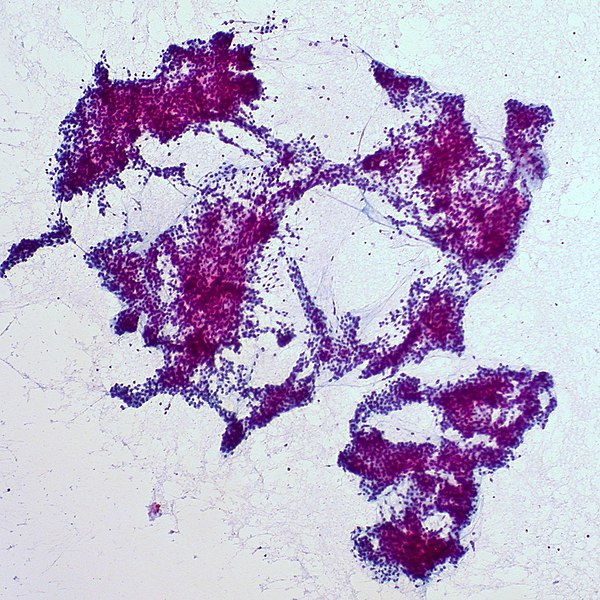 File:Parathyroid Adenoma, FNA (5691611916).jpg