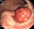 Gestielter Dickdarmpolyp