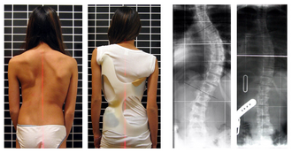 A Cheneau brace achieving correction from 56deg to 27deg Cobb angle Scoliosis patient in cheneau brace correcting from 56 to 27 deg.png