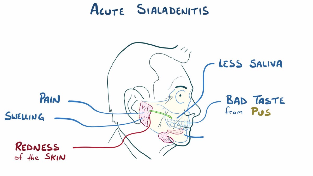 Sialadenitis  