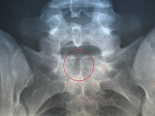 Spina Bifida pelvis X-ray.jpg