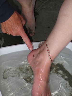 Stingray injury.jpg