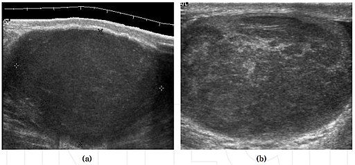 Ultrasound images of seminomas