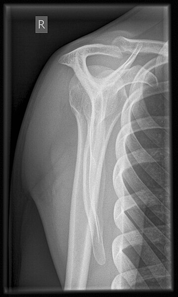 File:Y CR shoulder.jpg