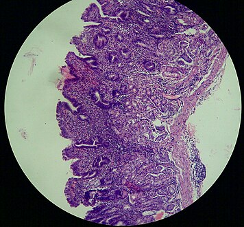 Atrophic gastritis