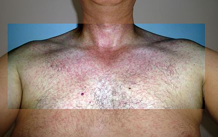 Rash during Zika fever infection