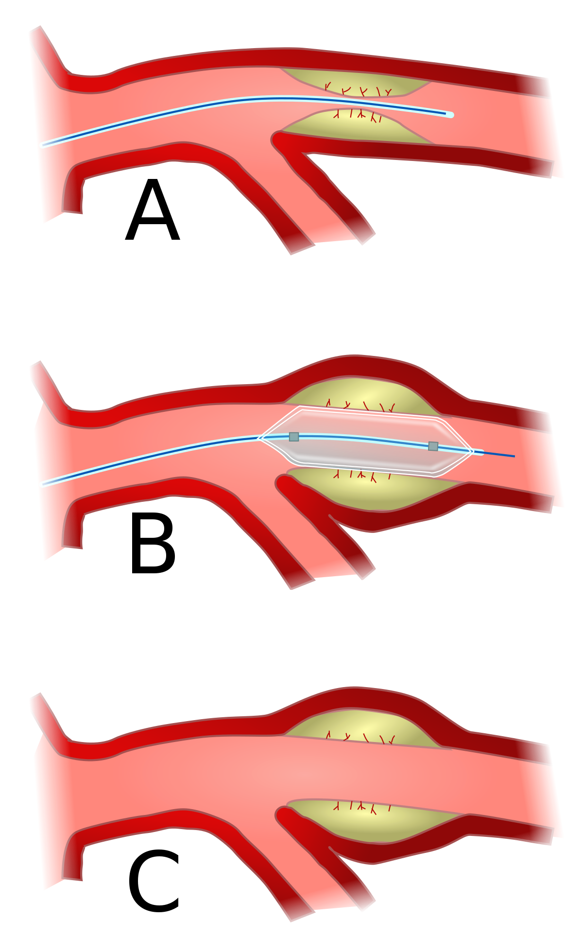 Angioplasty - Wikipedia
