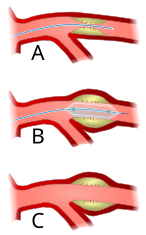 Otherwise called balloon angioplasty. Procedure to widen the narrowed artery that supplies blood to the heart. Angioplasty-scheme.svg