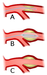 Angioplasty Procedure to widen narrow arteries or veins