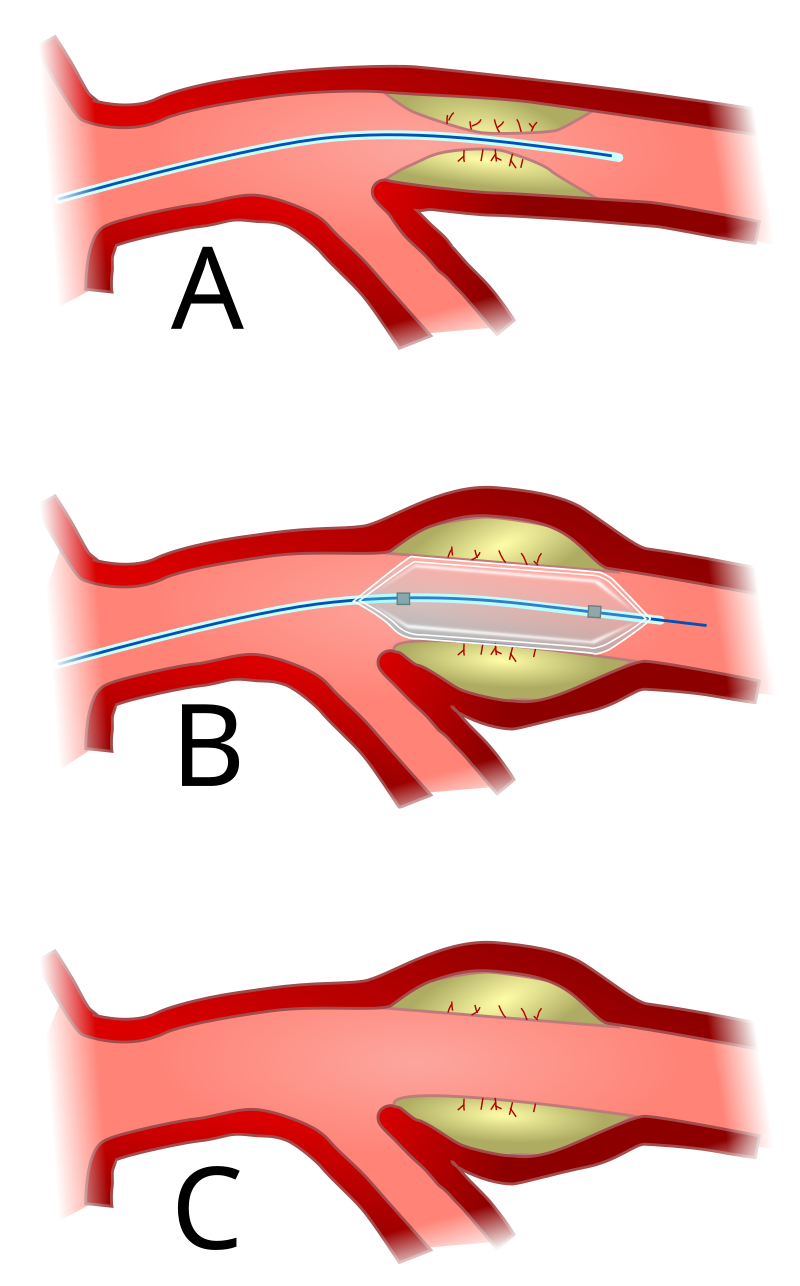 Angioplasty and stent placement - heart: MedlinePlus Medical