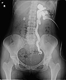 Antegrade pyelogram of grade III hydronephrosis with obstruction at the ureterovesical junction.jpg