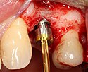 K fixátoru implantátu se připevní hojící se abutment a kolem hojícího se abutmentu se sešije gingivální lalok.