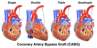 Coronary artery bypass surgery types.