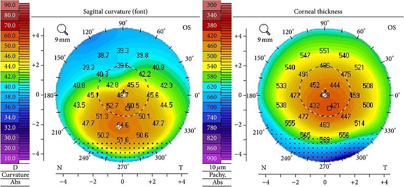 File:Corneal topography, stage II keratoconus (Elise A. Slim et al.).jpg