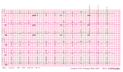 Thumbnail for File:De-Brugada syndrome type1 example4 (CardioNetworks ECGpedia).png