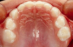 Dentición Decidua: Cronología, Primera dentición en el bebé, Los dientes temporales