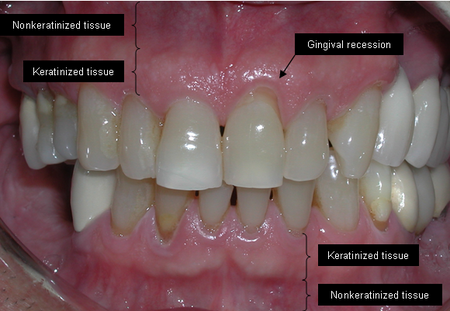 Gingival tissue.png