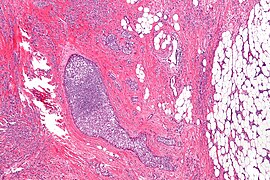 Lobular carcinoma - low mag.jpg