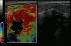 Elastography shows stiff cancer tissue on ultrasound imaging.
