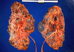 Polycystic kidneys, gross pathology 20G0027 lores.jpg