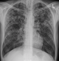 تصوير الصدر بالأشعة السينية يوضح السل الدخني