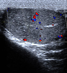 Ultrasound of segmental testicular infarction. Infarct area shown as hypoechoic and avascular upper segment of R testis. Segmental testicular infarction 112914968.jpg