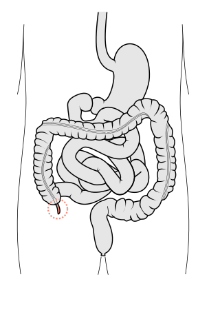 <span class="mw-page-title-main">Appendix (anatomy)</span> Tube attached to the intestine