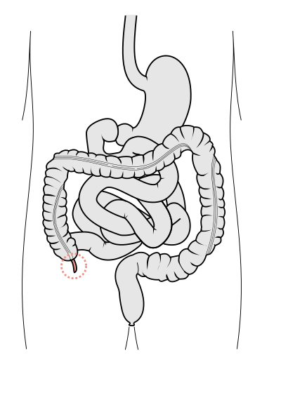 صورة:Tractus intestinalis appendix vermiformis.svg