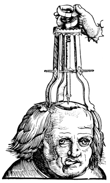 File:Trepanation - feldbuch-der wundartzney.png