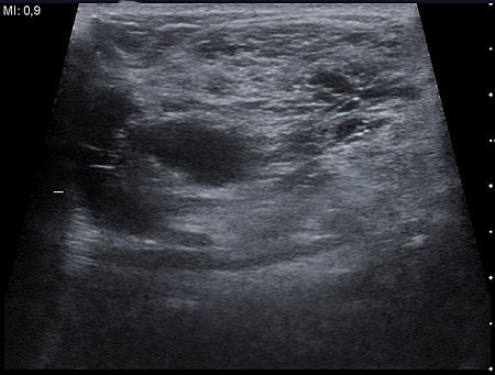 Ultrasound image Cystic Hygroma 20170641359 17F.jpg