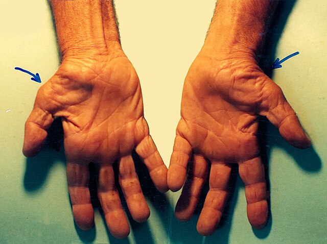 Carpal tunnel syndrome - Wikipedia