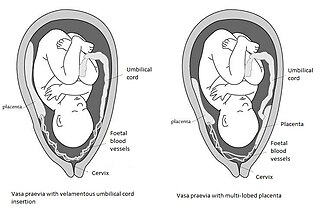 Vasa praevia Condition in which fetal blood vessels cross or run near the internal opening of the uterus.