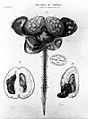 'Maladies du cerveau', Cruveilhier, 1829 Wellcome L0021289.jpg