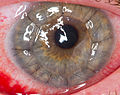 A human eye 1 day after a cornea transplant.jpg