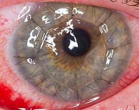 A human eye 1 day after a cornea transplant.jpg