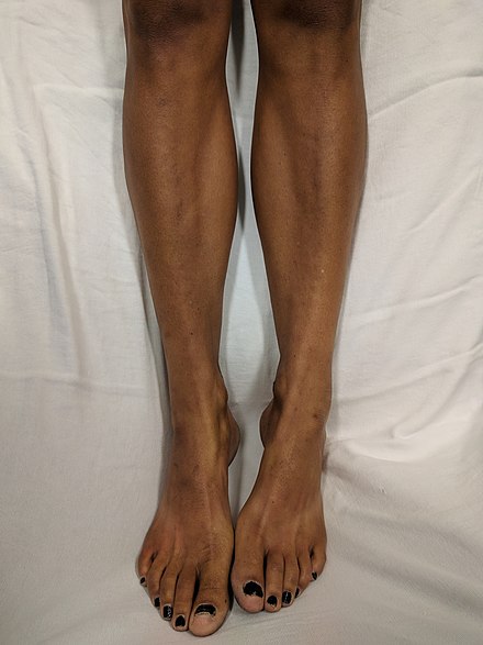 Darkening of the skin seen on the legs of an otherwise fair-skinned patient