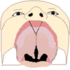 Cleft palate 1 bot.png