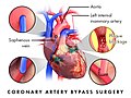 Coronary artery bypass graft.