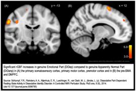 Dissociative identity disorder neuroscience brain imaging.png